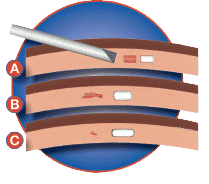 solidoseimplantdiagram